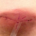 Under my right breast. 11 days post op.