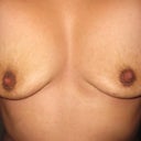 2 months 3 weeks after op.