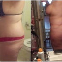 Before and 6 months post op