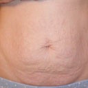 Before surgery