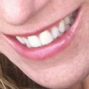Before injections