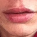 Immediately after injection. Notice more swelling on right upper lip.