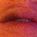 Evening of injection day. Notice purple bruise forming.
