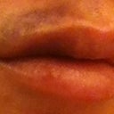 Day 3 morning. Bruise is very visible.