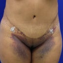 Post op day 7