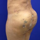 Post op day 7