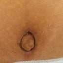 Belly Button Post Op Day 13.