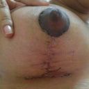 Right Breast Post Op Day 13.