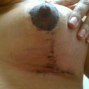 Left Breast Post Op Day 13