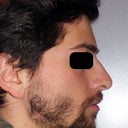 Nose before the OP