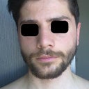1 Month post-OP: Front view. Nose looks a bit bulky and wide, especially on mornings.