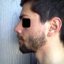 1 Month post-OP: Right Side view.