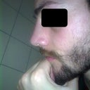 1 Month post-OP: Right side from different angle.