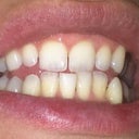 Start, before first aligner.