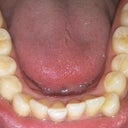 Before first aligner.