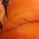 4 weeks, 4 days PO - scar close up