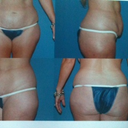 Before pictures are a little distorted and wide since i took from my iphone off a photo but the shape is the same.