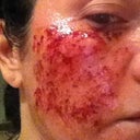 Day of Procedure