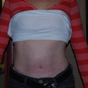 4 weeks post op