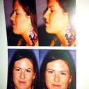 The left is what I am right now, and the right is what the dr says he will change it to...is the change even noticeable??  Should I point the tip more?