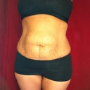 Before Pic Day Of surgery Couple Hours Before
Not a Happy Mommy:( Hated My stomach!