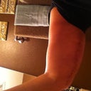 After surgery right arm