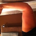 Left arm after sugery this ones bigger than the right :-(