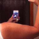 Back of arm after surgery