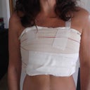 first day post op!