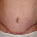 7 weeks - My scar reminds me of Iron Man's helmet!