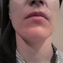 Scar that looks like line on the left above upper lip