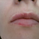 Scar that looks like line on the left above upper lip