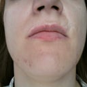 Scar that looks like line on the left above upper lip