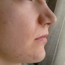 Small scar on the cheek on the left