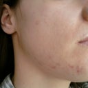 Small scar on the cheek on the left