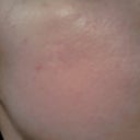 Small scar on the cheek on the left