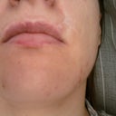 Biggest scar above upper lip on the right
