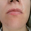 Biggest scar above upper lip on the right