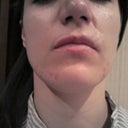 Biggest scar above upper lip on the right