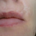 Biggest scar above lip on the right
