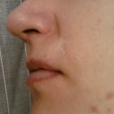 Biggest scar above upper lip on the right