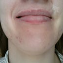 Biggest scar above upper lip on the right