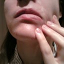 Scar stretching