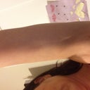 Left arm is tender, has hard lumps, and dents