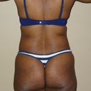 Before-back bra roll AKA back fat