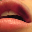 Upper lip bruising