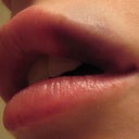 Upper lip bruising