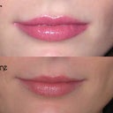 Four days after, a little uneven with some lower lip swelling and bruising.