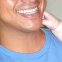22 weeks into treatment; aligners 11 of 24.