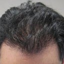 12 mo-after